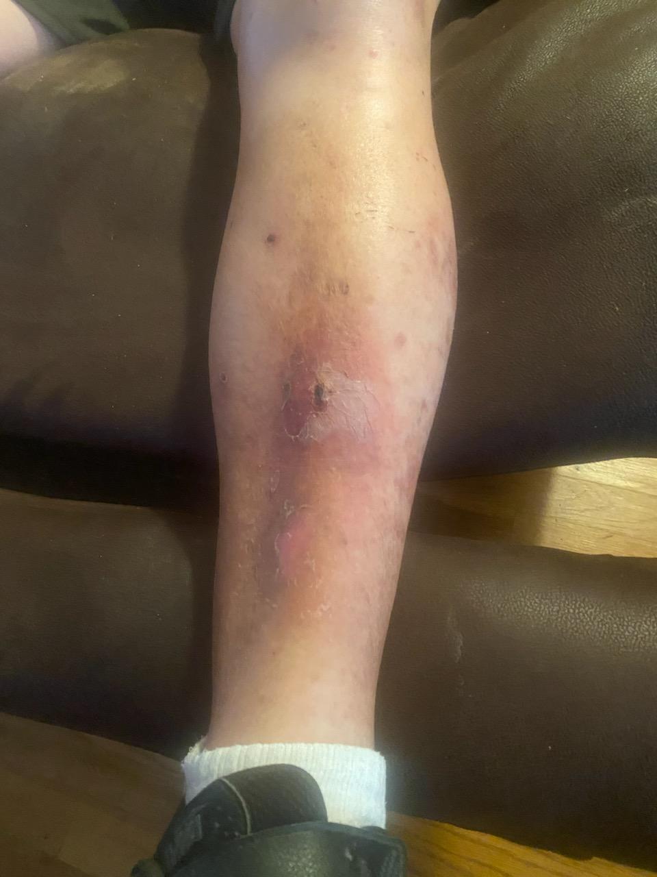 Leg wound after treatment with Peripheral Neuropathy MSM Cream