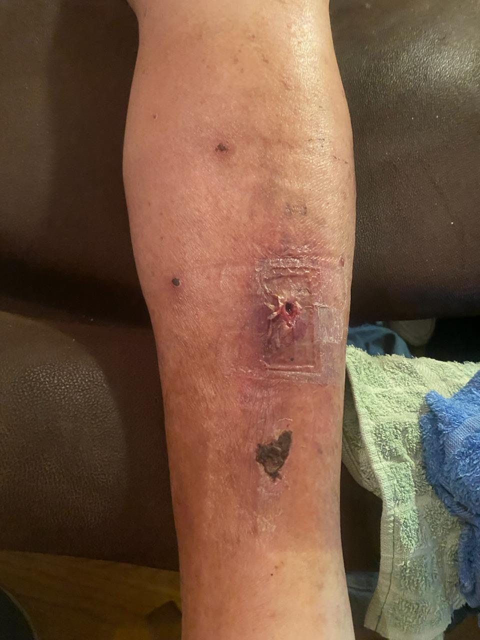 Leg wound before treatment with Peripheral Neuropathy MSM Cream