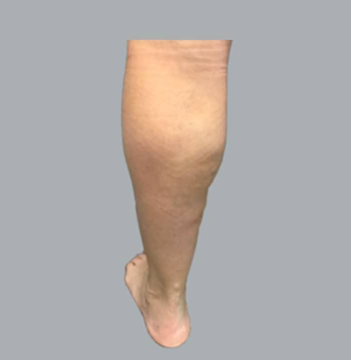 Varicose veins after treatment with Face, Skin, and Joint cream along with Neuropathy MSM cream